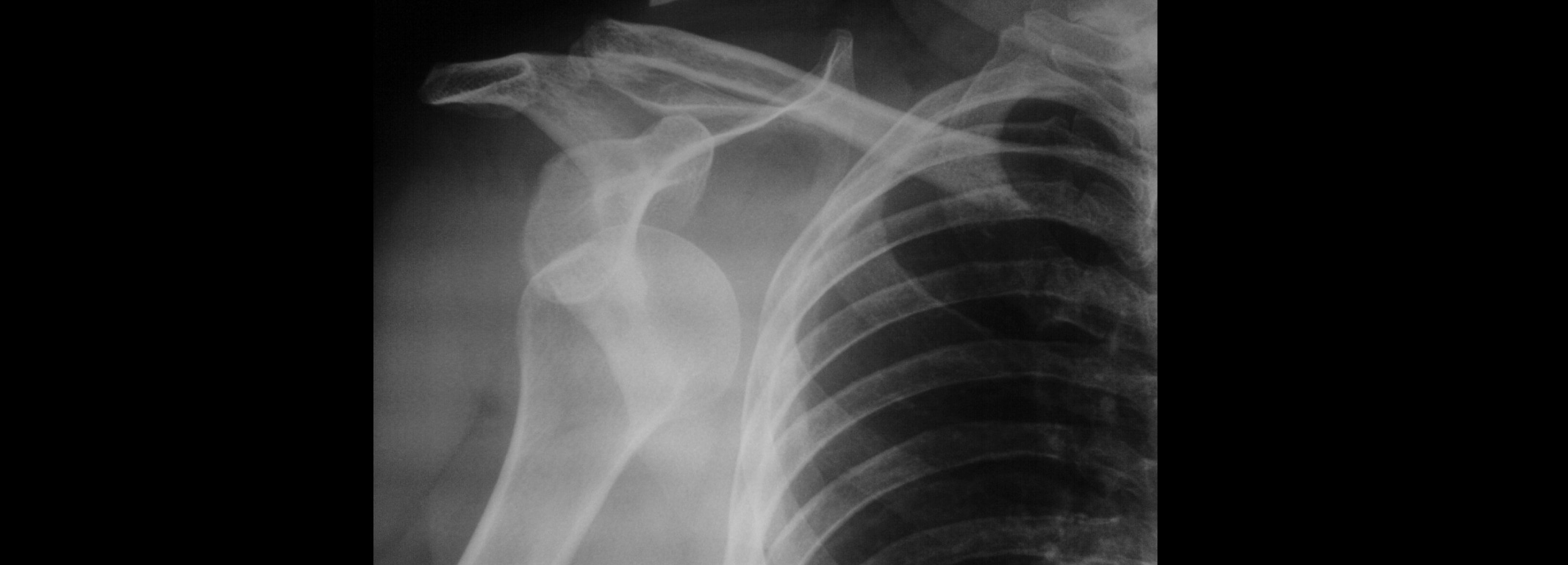 Luxación de hombro tratamiento y recuperación