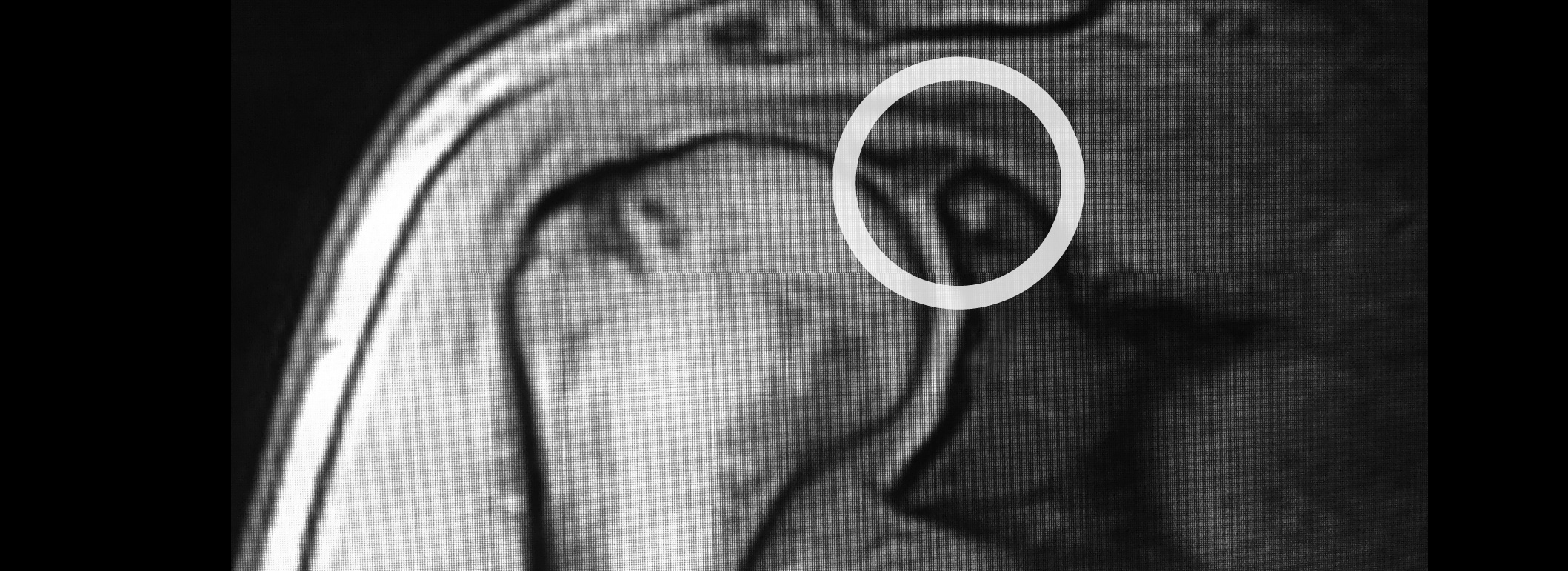 lesiones de slap en el hombro