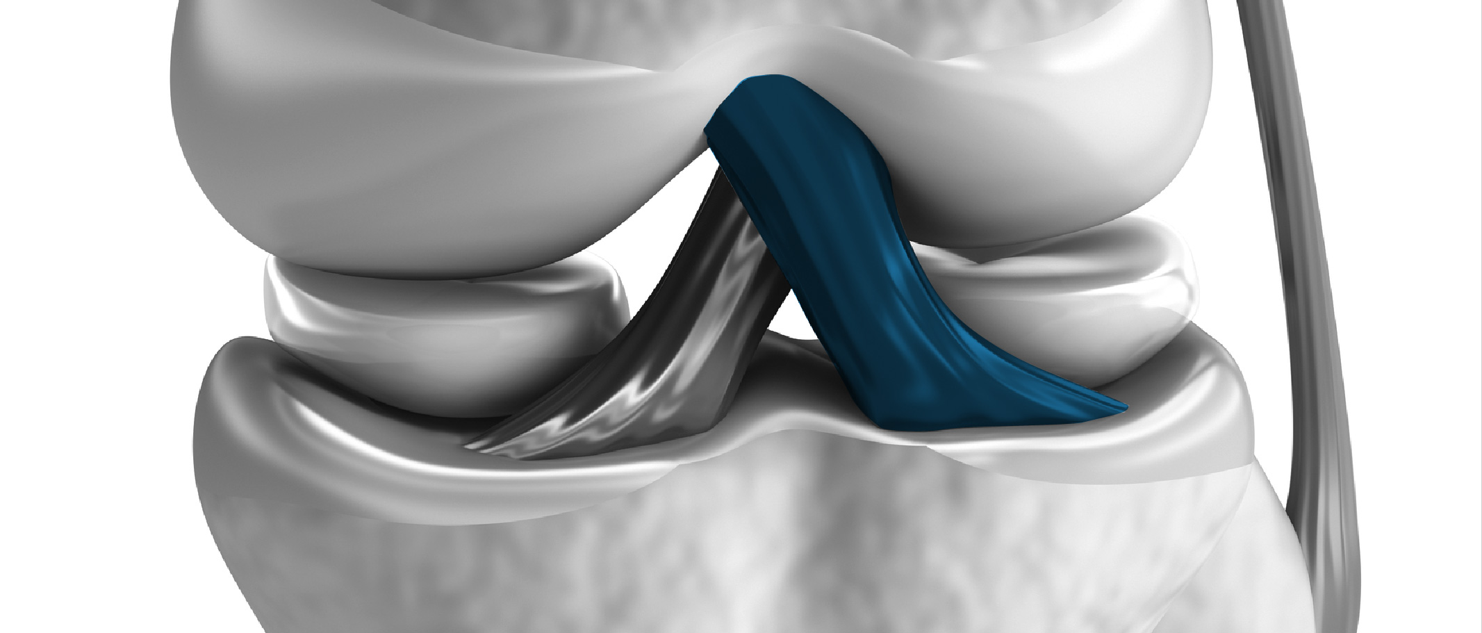 Tratamiento del ligamento cruzado anterior