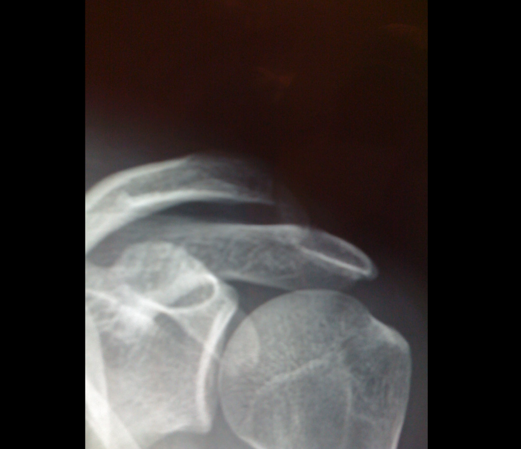 Tipo de luxación acromioclavicular