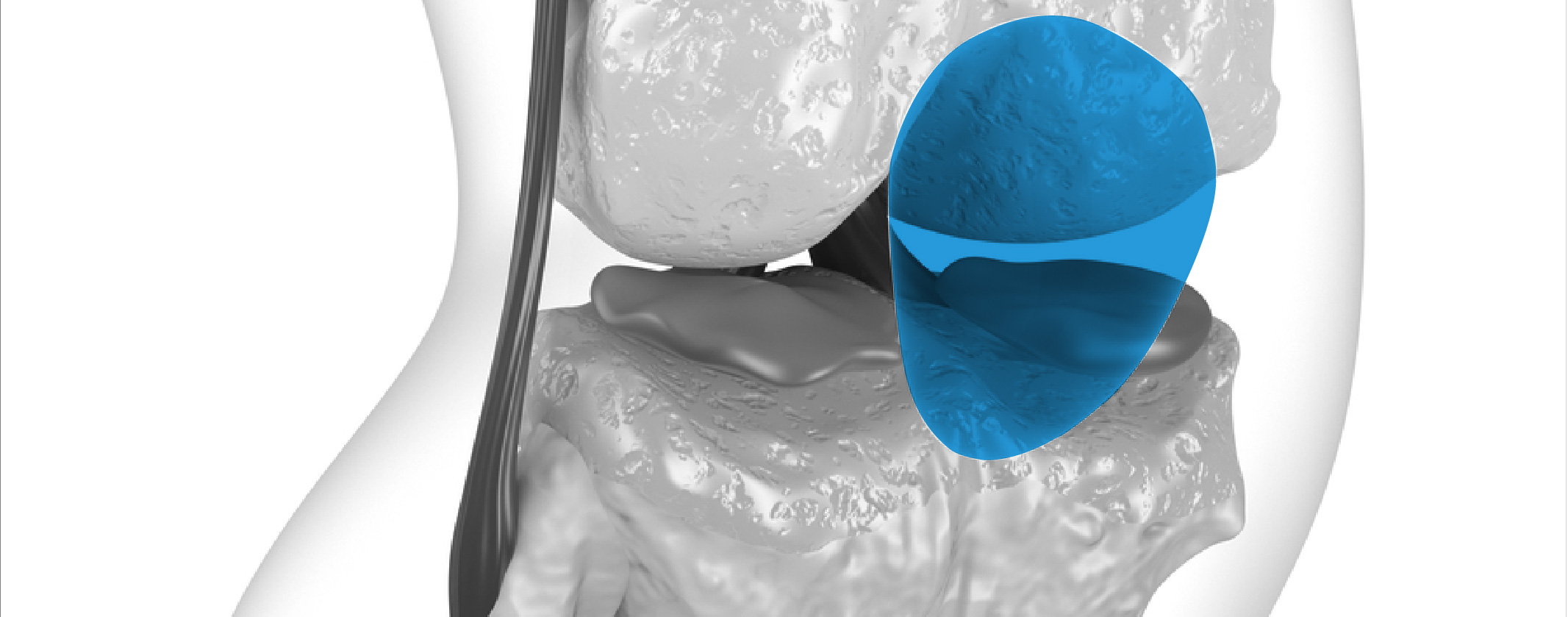 Tipos de luxación de rodilla: luxación de rotula