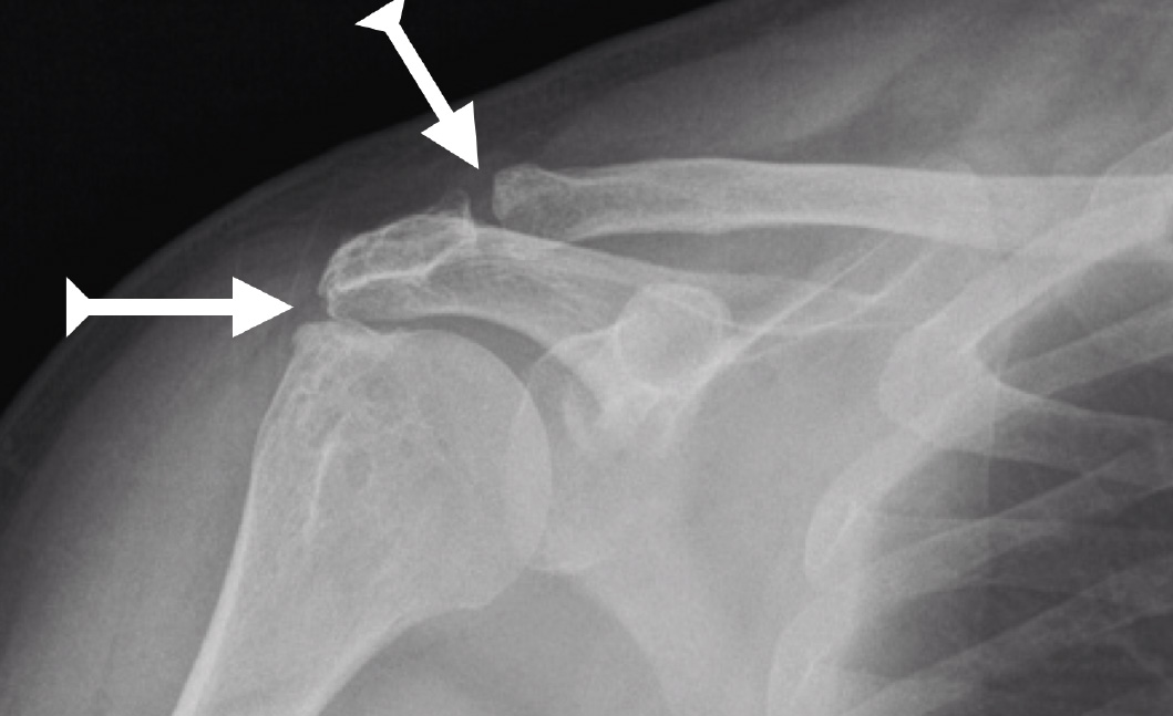 Lesión por síndrome de pinzamiento del hombro
