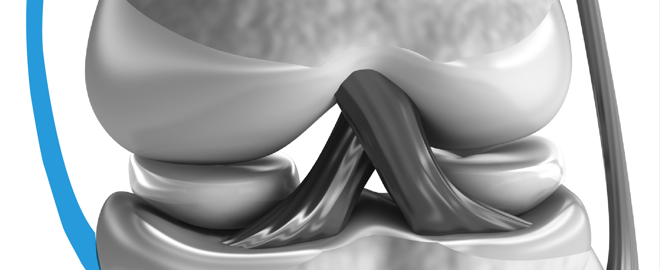 Lesion de ligamentos de rodilla y tratamiento