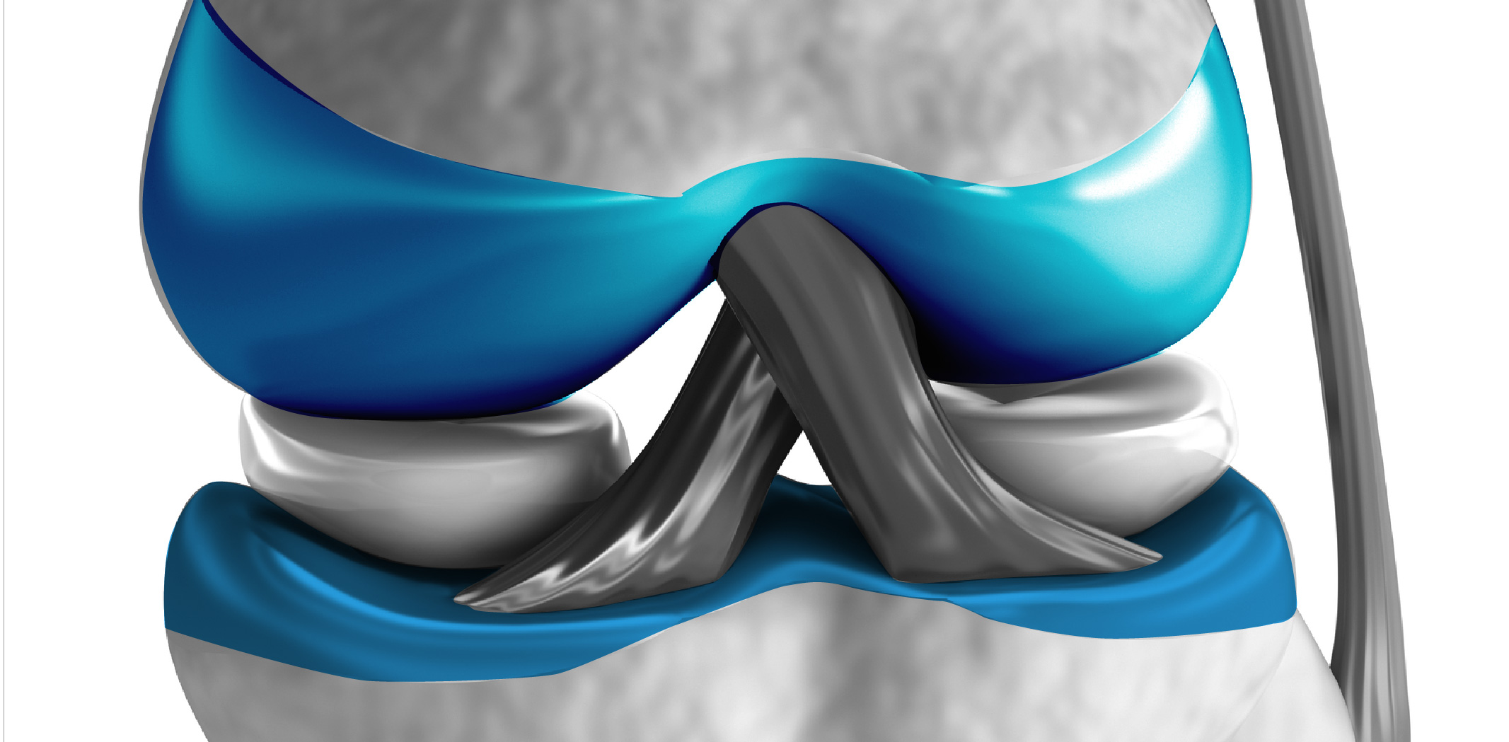 Cirugia de rodilla por desgaste de cartilago