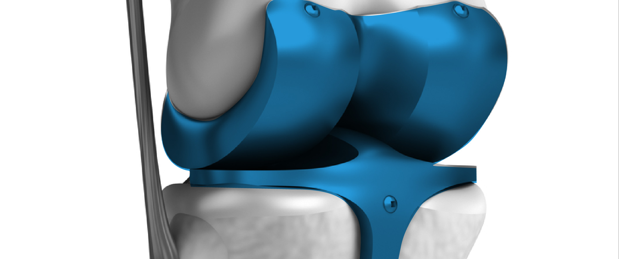 Reemplazo articular de rodilla por lesión